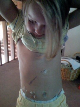 A young girl with blonde hair looking down at her bare torso which has several marks on it.